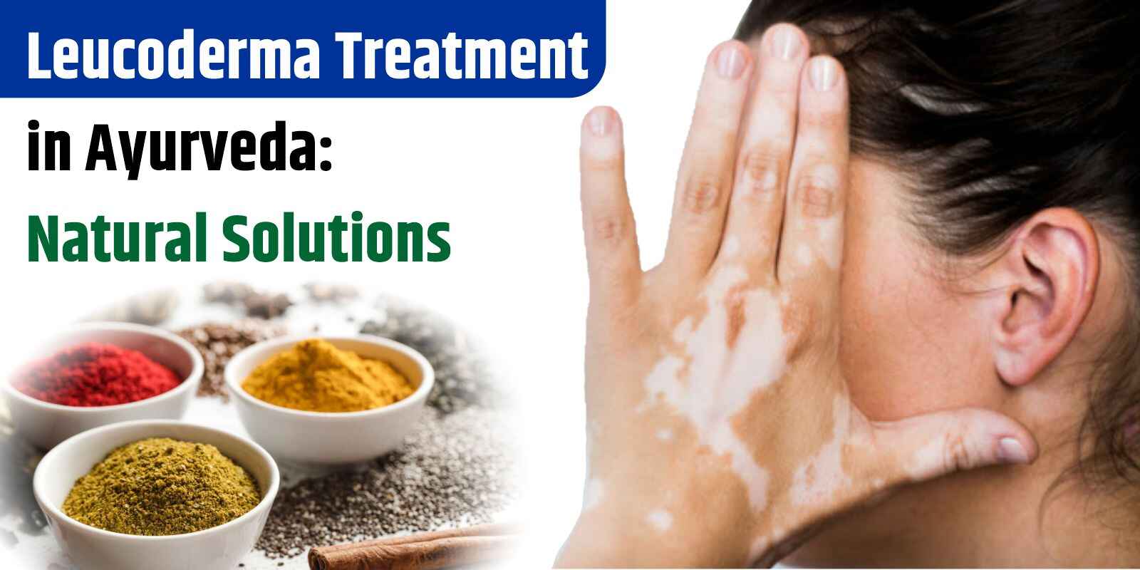 Leucoderma Treatment in Ayurveda: Natural Solutions